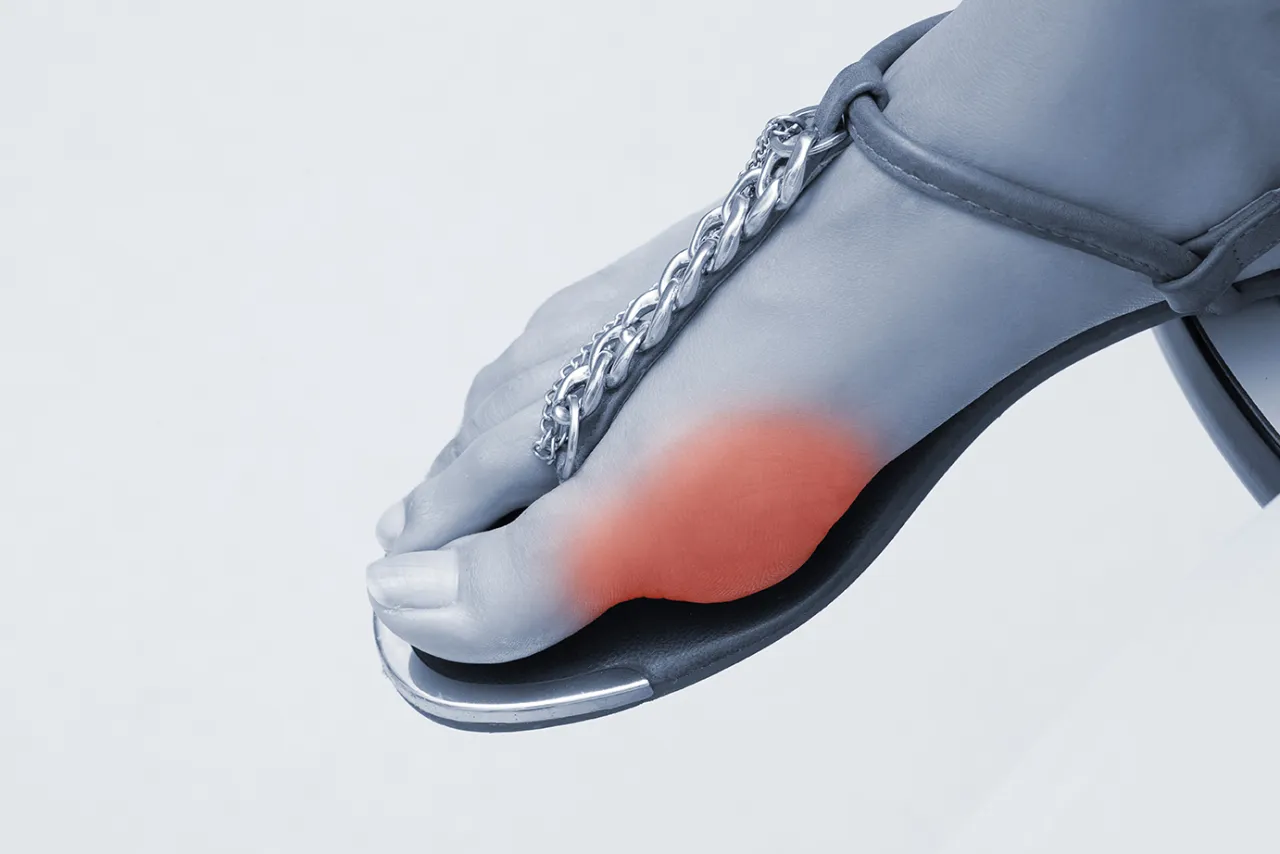 leczenie zachowawcze haluksów aparaty wkładki