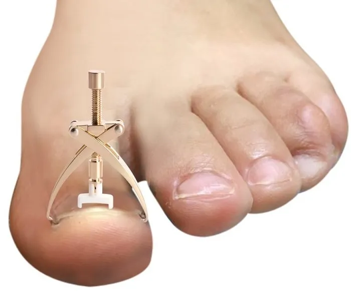 Klamra ortonyksyjna na wrastający paznokieć