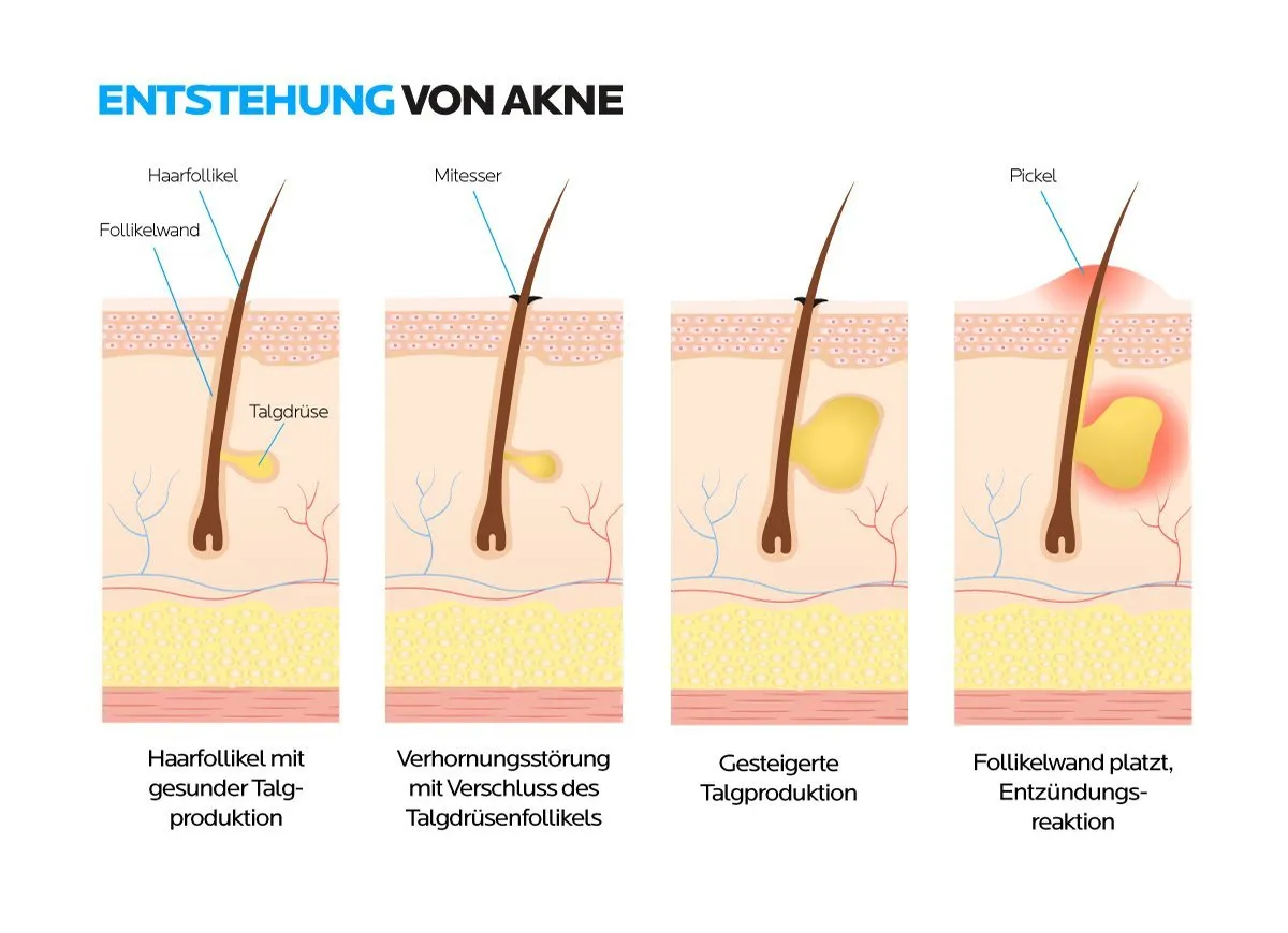 Wirkstoffe gegen unreine Haut Tabelle
