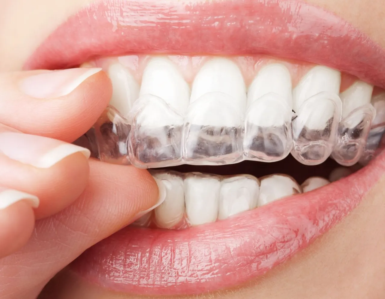 Szyna relaksacyjna na zęby