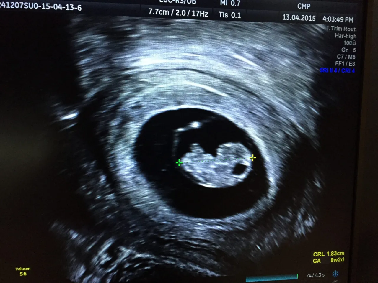 pierwsze usg ciąży crl