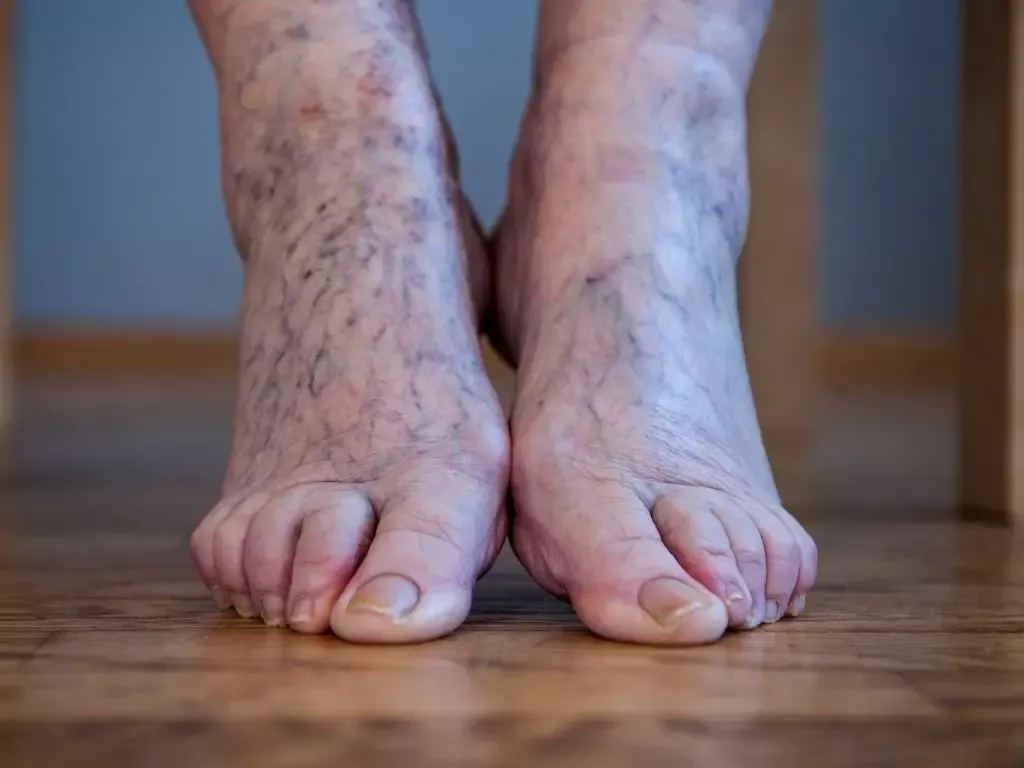 objawy chorób naczyniowych nóg, żylaki obrzęk nóg