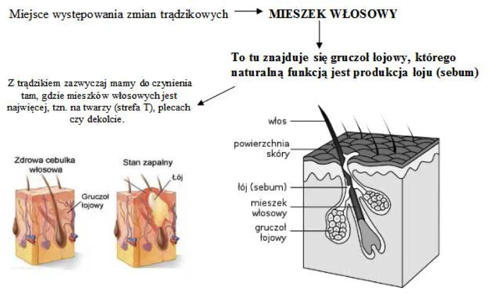 przyczyny trądziku schemat