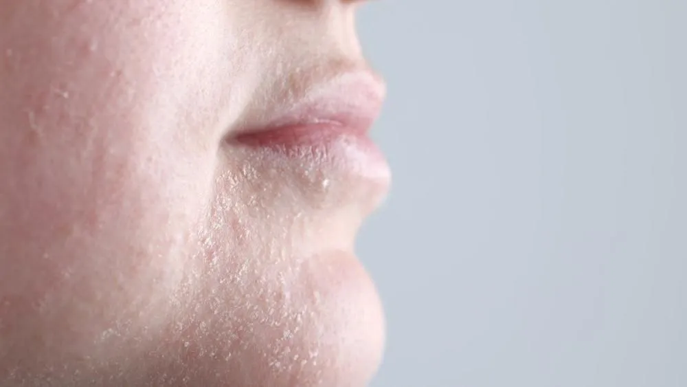 objawy uszkodzonej bariery hydrolipidowej, sk&oacute;ra sucha zaczerwieniona