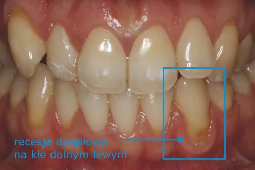 Recesja dziąseł przykłady