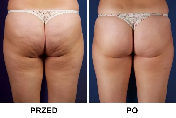 profesjonalne zabiegi na cellulit, endermologia, fala uderzeniowa