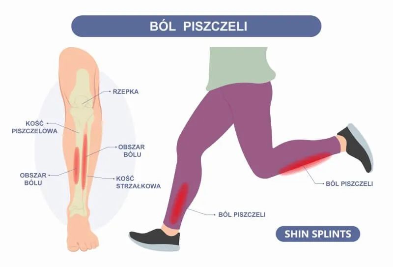 mapa b&oacute;lu goleni shin splints złamanie zmęczeniowe