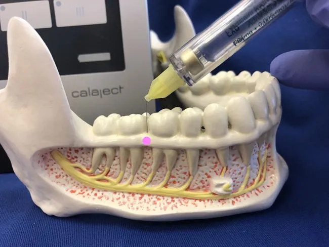 znieczulenie miejscowe u dentysty schemat