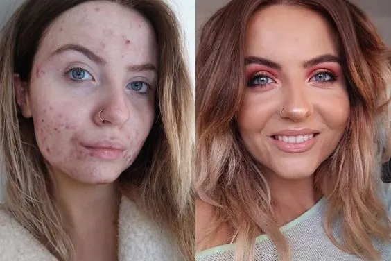 przed i po makijażu cery trądzikowej