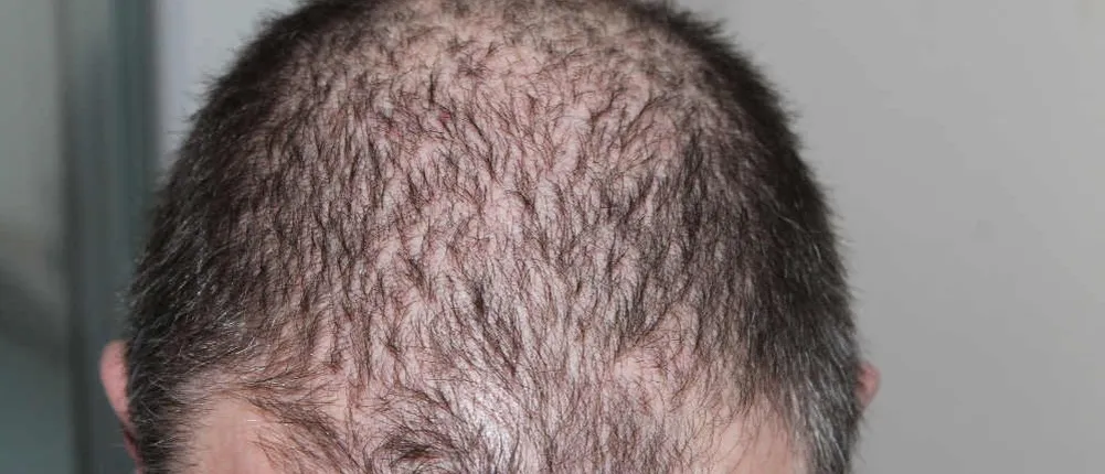 Haarausfall Ursachen N&auml;hrstoffmangel