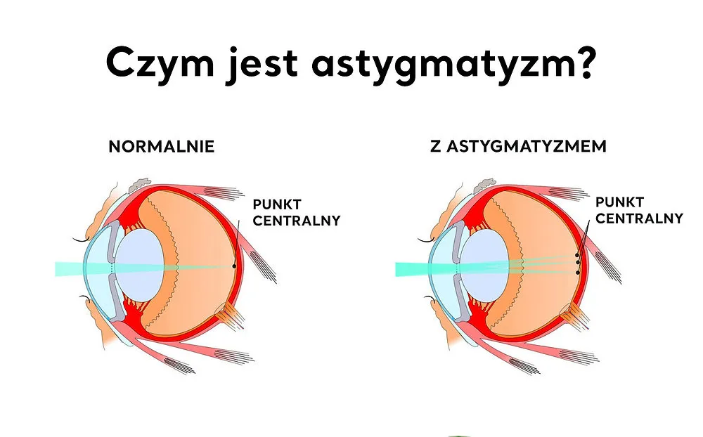 rodzaje korekcji astygmatyzmu okulary soczewki laser