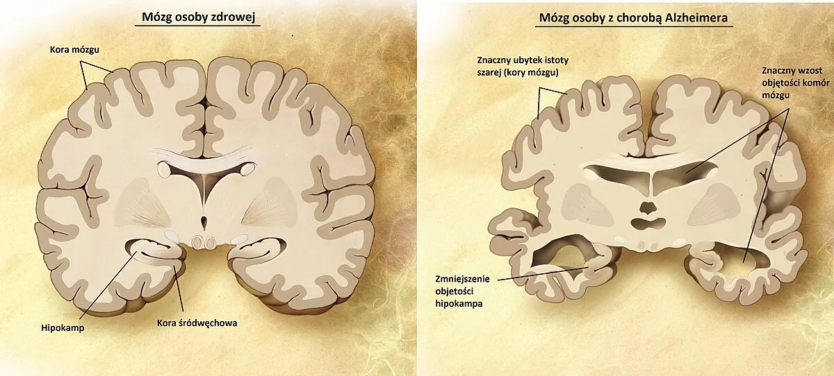 Mózg neurony choroba neurodegeneracyjna