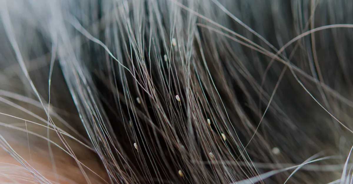 wszy i gnidy na włosach dziecka zdjęcia