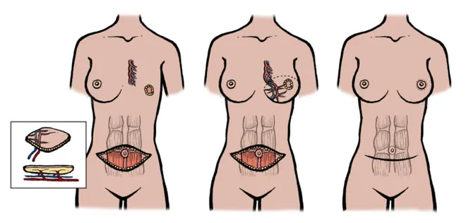 schemat operacji onkoplastycznej piersi, rekonstrukcja piersi po lumpektomii