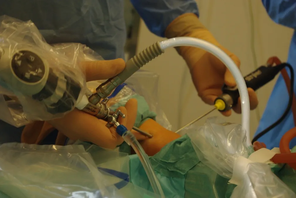 Zdjęcie Ile trwa rehabilitacja po artroskopii stawu skokowego i co wpływa na czas?