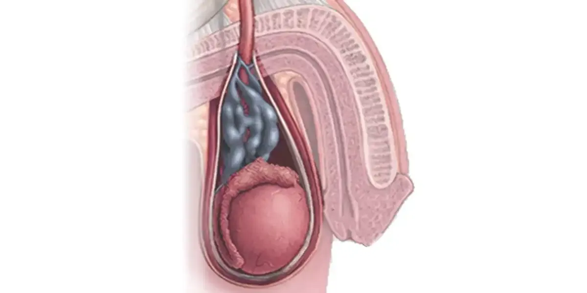 Zdjęcie Skutki uboczne operacji żylaków powrózka nasiennego – co warto wiedzieć?