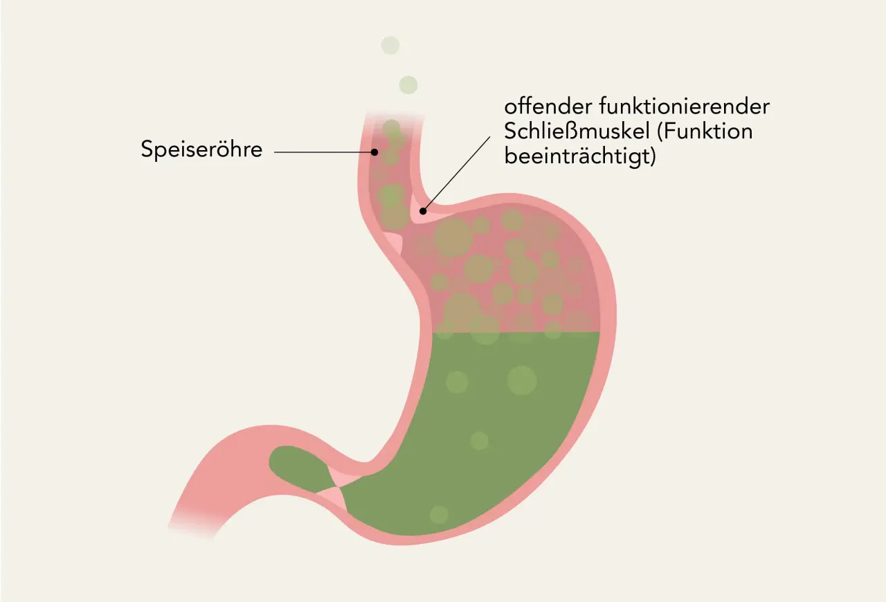 Zdjęcie Refluxkrankheit Symptome: Erkennen Sie die Anzeichen und vermeiden Sie Schmerzen