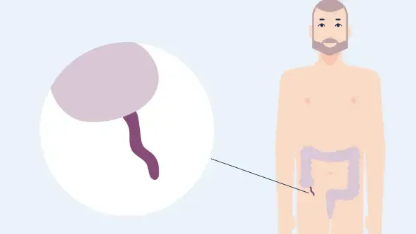 Zdjęcie Wichtige Symptome einer Blinddarmentzündung: So erkennen Sie sie rechtzeitig