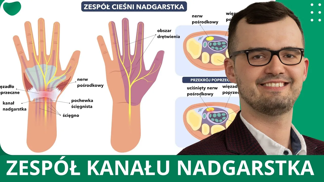Zdjęcie Jakie leki na zespół cieśni nadgarstka mogą przynieść ulgę w bólu?