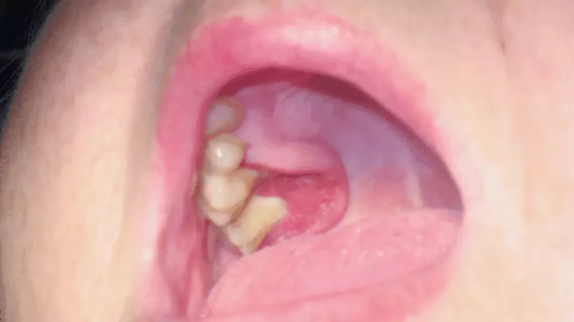 Zdjęcie Rak płaskonabłonkowy jamy ustnej objawy – jak je rozpoznać i reagować