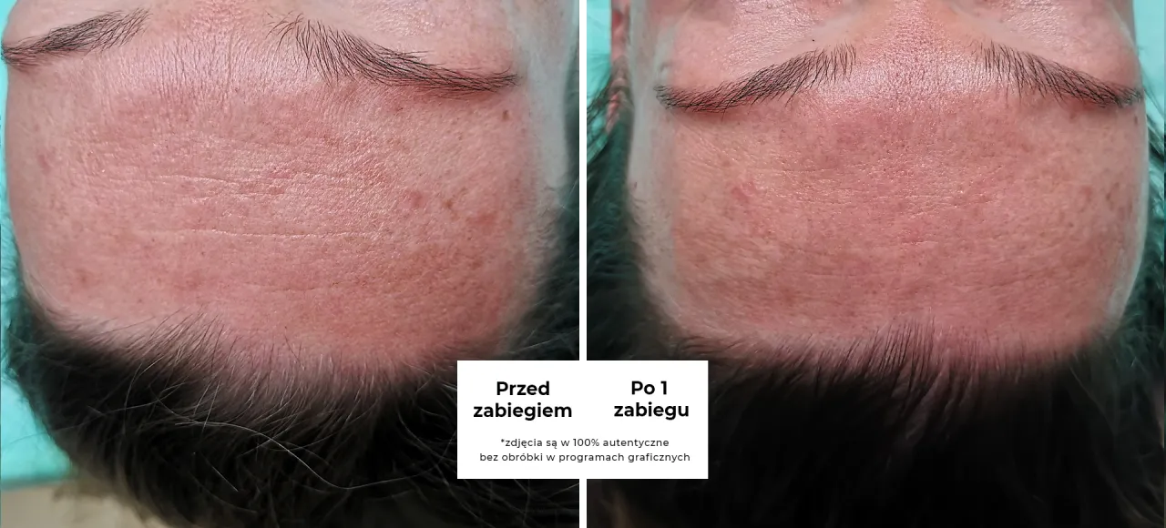 Masaż Kobido efekty przed i po