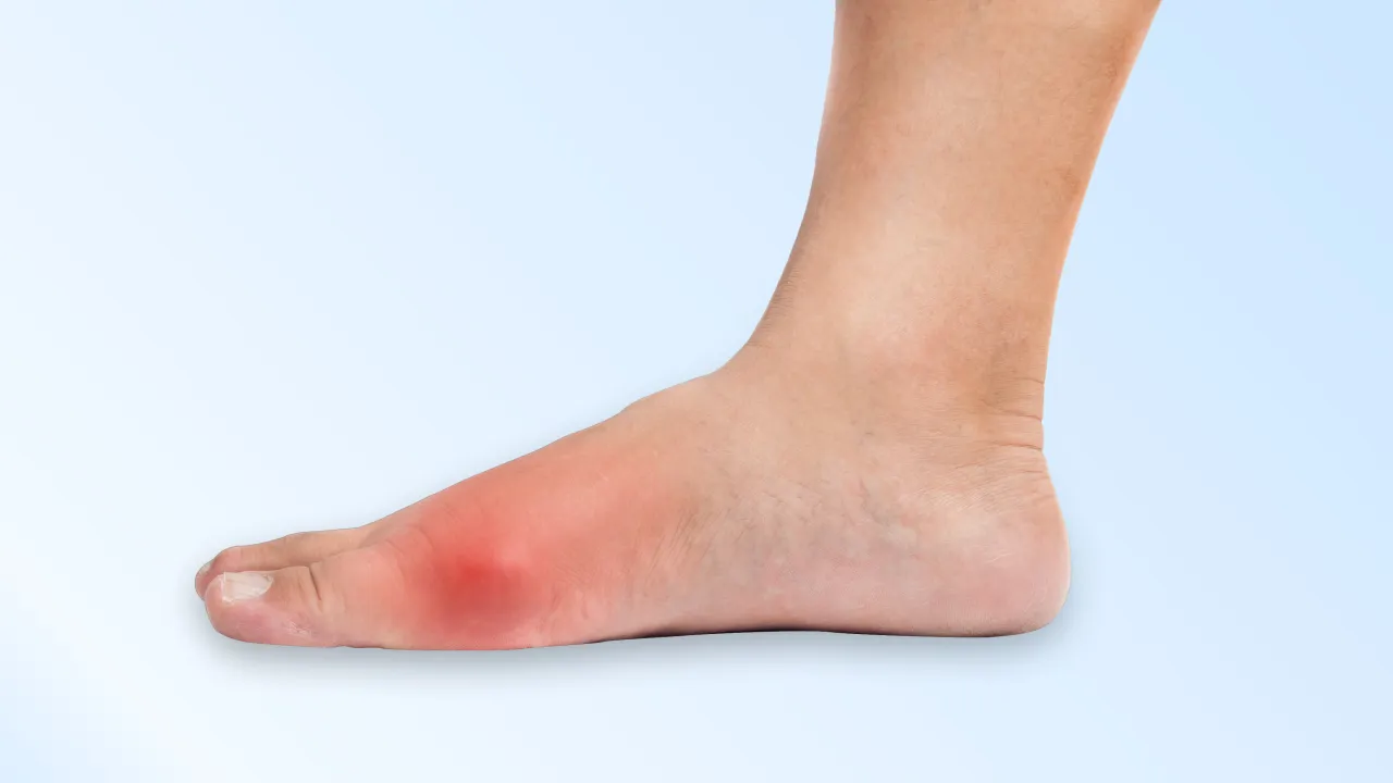 Zimny okład na bolący staw dny moczanowej