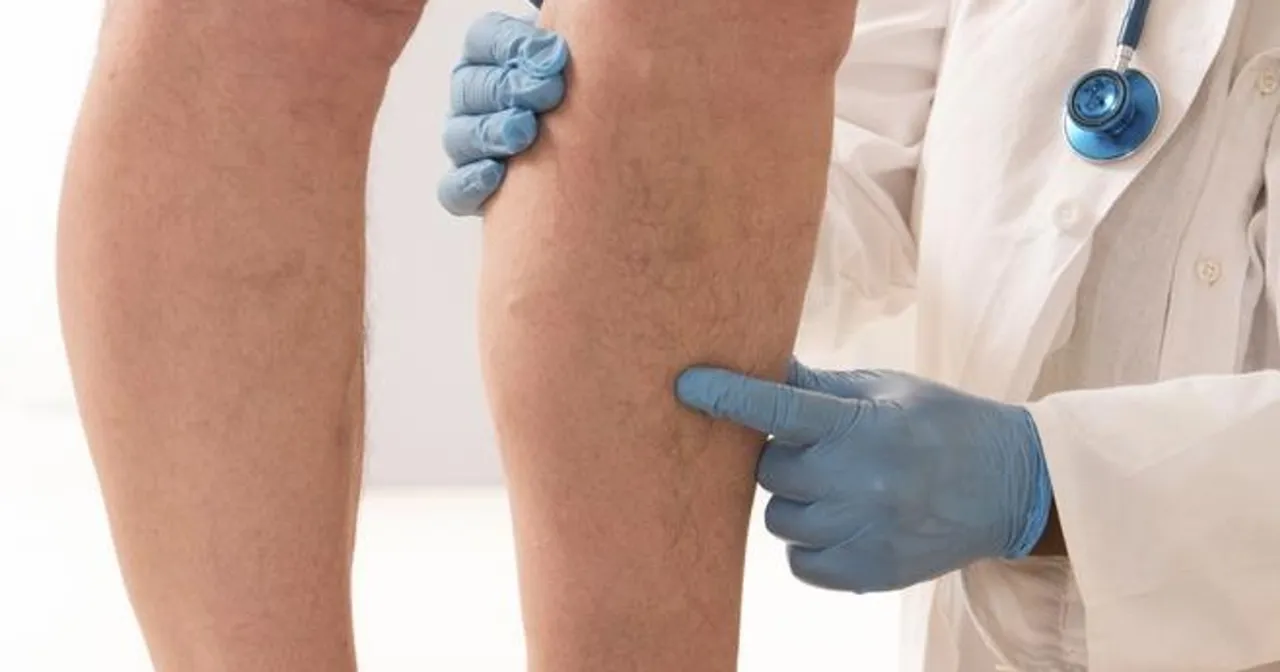 konsultacja lekarska zakrzepica