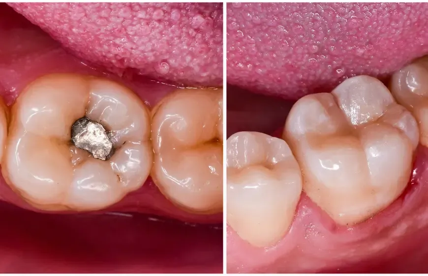 plomba amalgamatowa vs biała plomba r&oacute;żnice