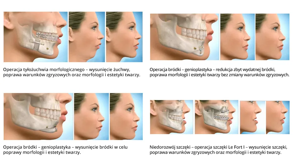 korekta zgryzu profil twarzy przed po