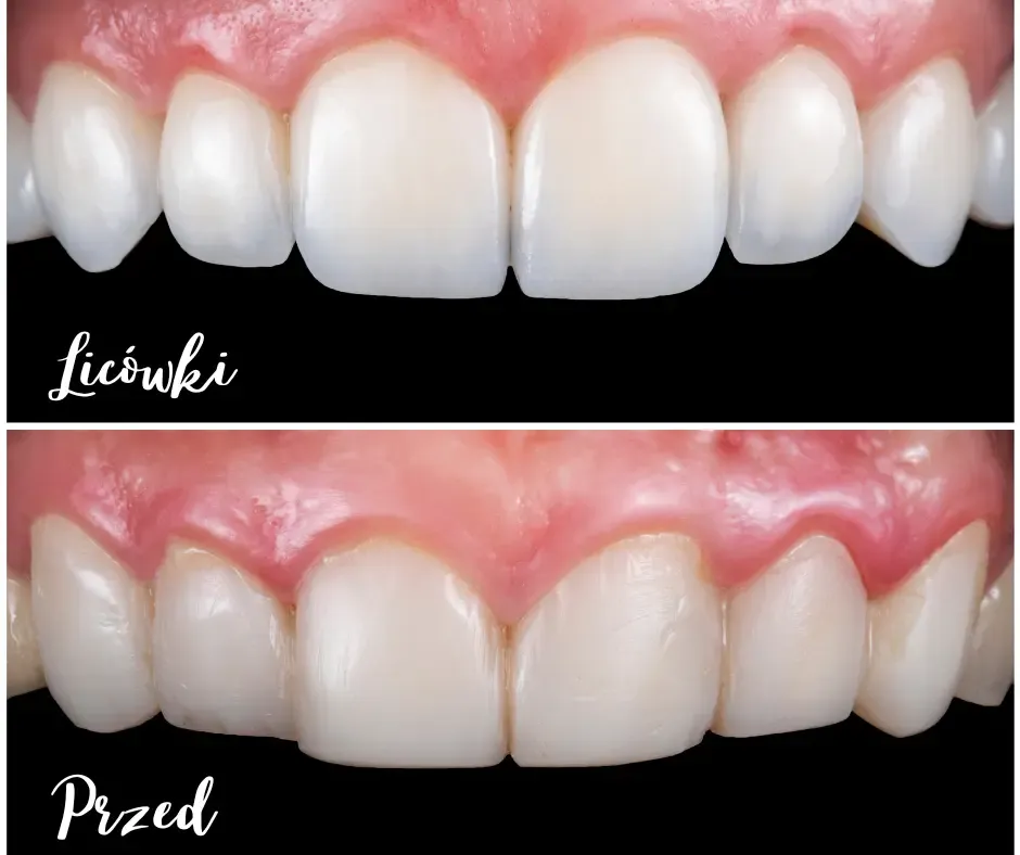 r&oacute;żne ilości lic&oacute;wek na zębach przednich por&oacute;wnanie