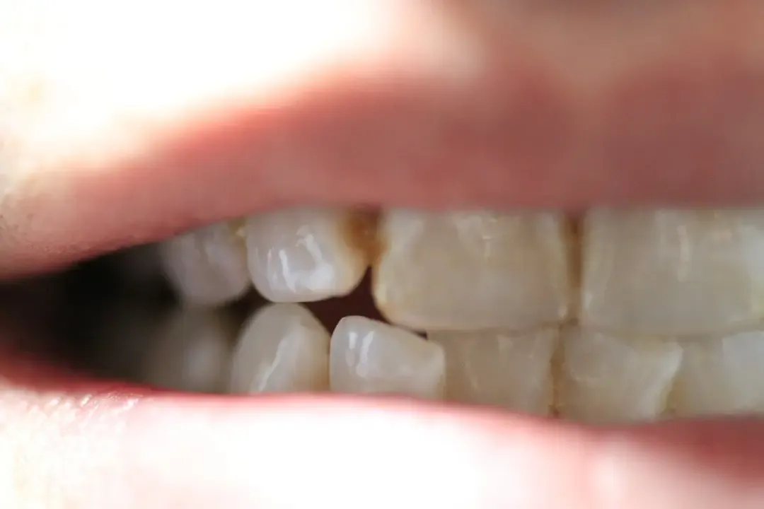 przyczyny przebarwień zębów, kawa herbata zęby, palenie papierosów zęby