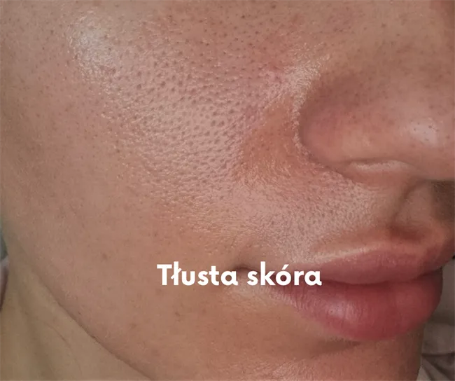 strefa T twarzy gruczoły łojowe