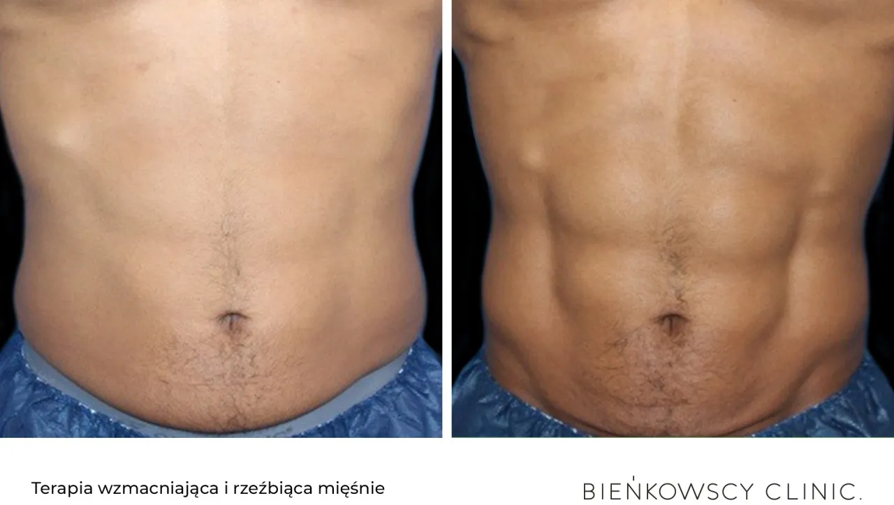 Przed i po zabiegu: elektrostymulacja mięśni brzucha efekty widoczne jako wyraźny zarys mięśni.