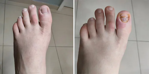 klamry ortonyksyjne przed i po