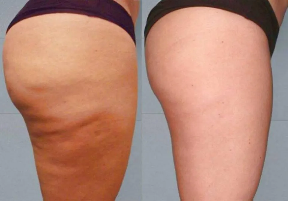 Icoone Endermologia efekty przed po cellulit