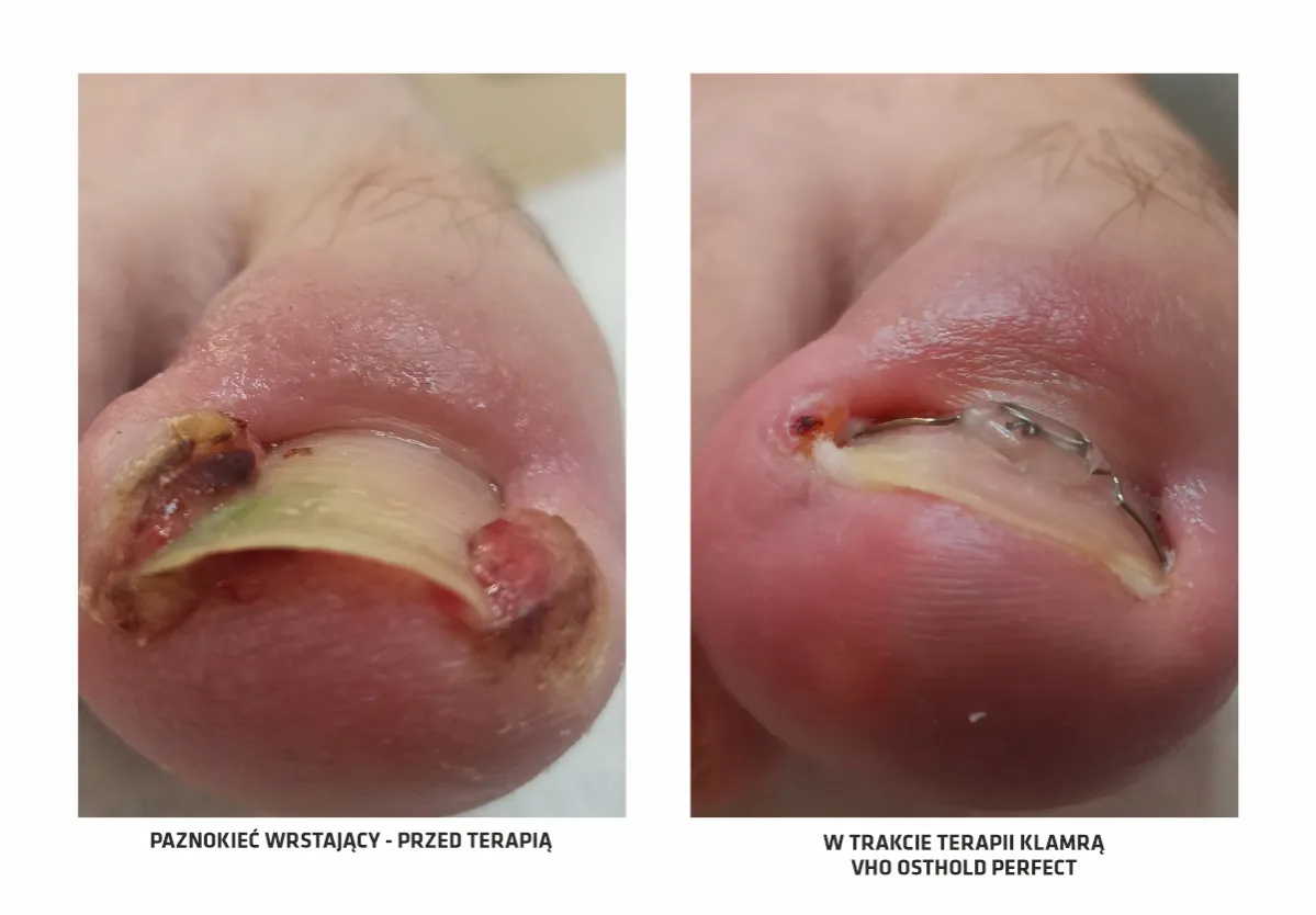 Przyczyny wrastających paznokci