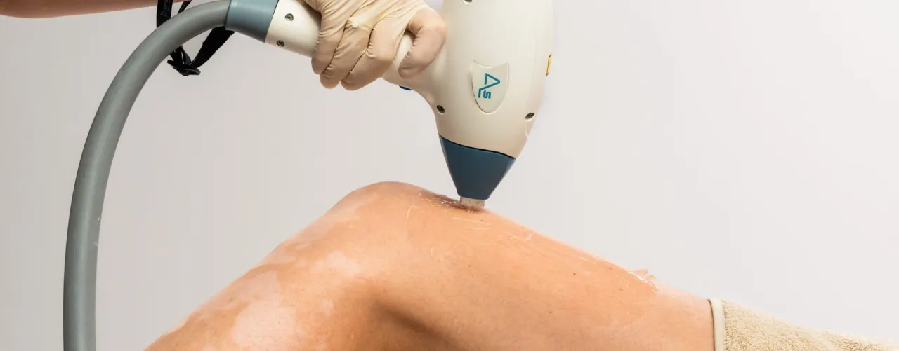 depilacja laserowa odstępy między zabiegami mapa ciała