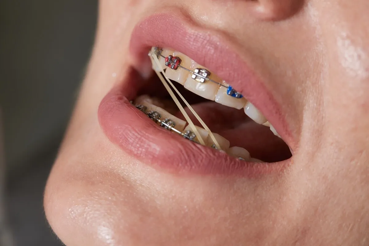 Wyciągi elastyczne w aparacie ortodontycznym