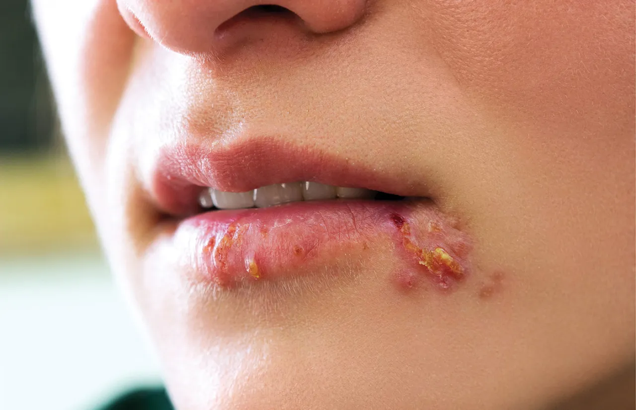 Opryszczka wargowa a wizyta u dentysty
