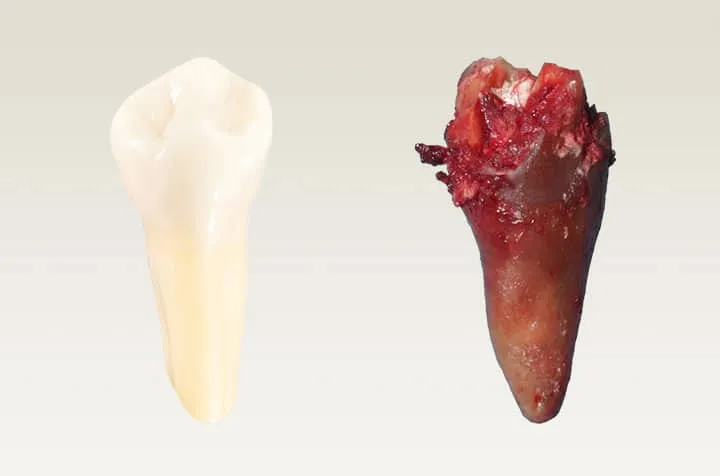 infekcja zęba bakterie pęknięty ząb