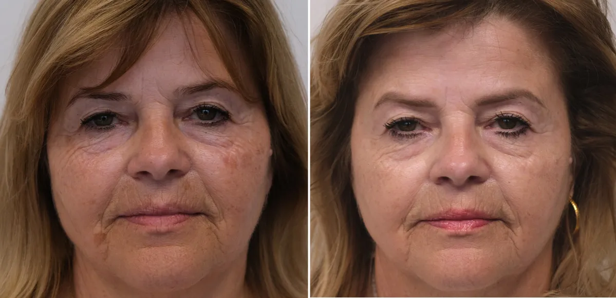 sfotoszopowane zdjęcie przed po