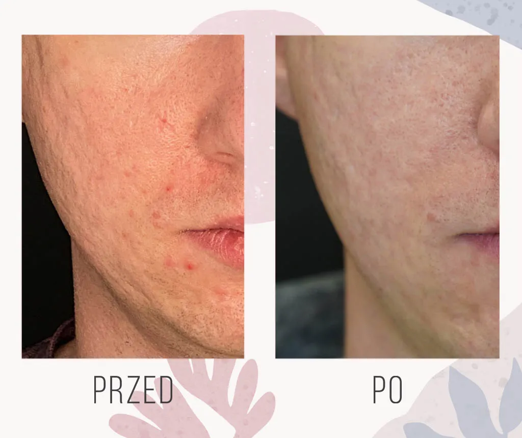 zabiegi laserowe na przebarwienia pozapalne przed i po