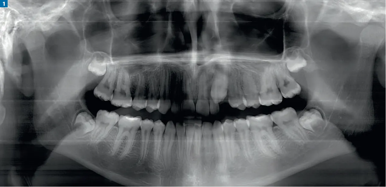 zdjęcie rentgenowskie zatrzymanego kła