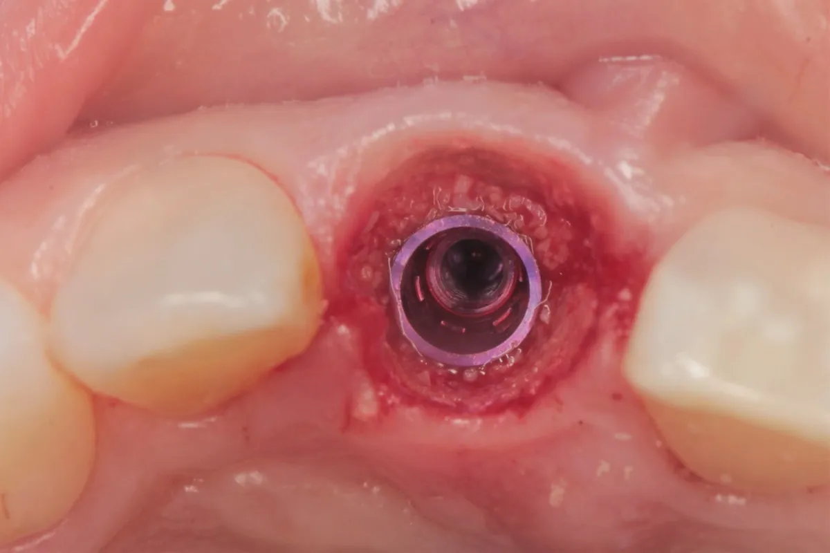 etapy gojenia dziąsła po ekstrakcji zęba