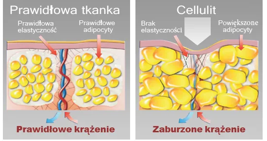 cellulit wiotka skóra tkanka tłuszczowa obrzęki