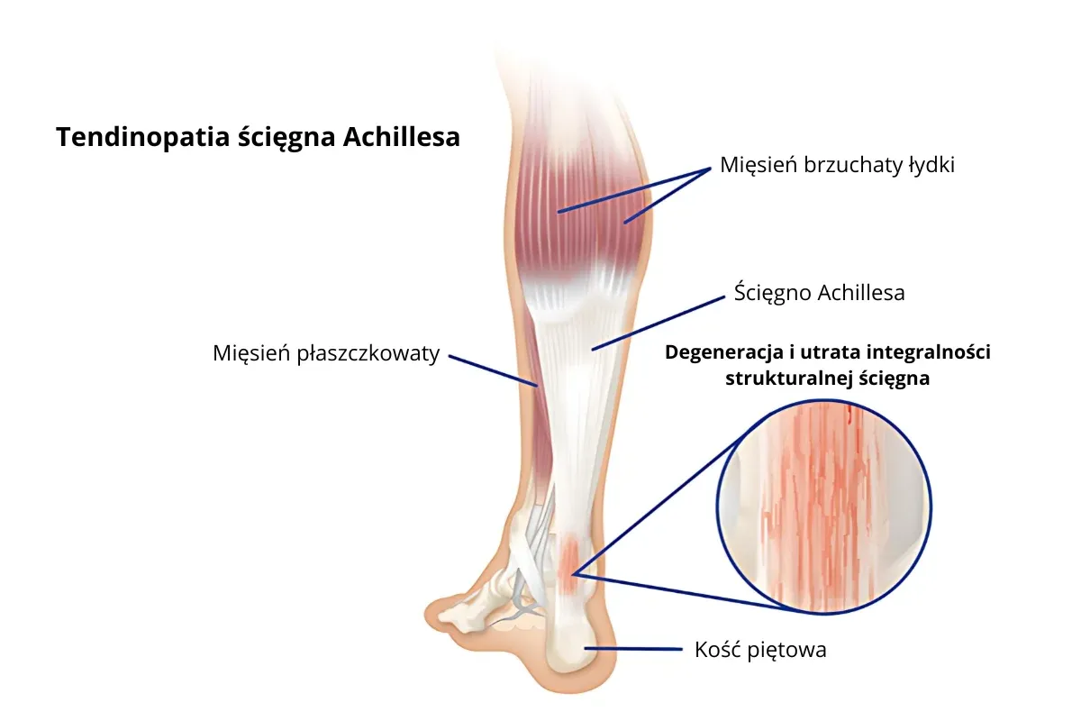 Anatomia ścięgna Achillesa i mięśni łydki