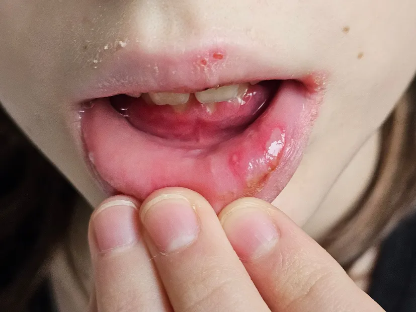 Dieta dla dziecka z opryszczkowym zapaleniem jamy ustnej