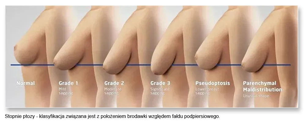 chirurgiczny lifting biustu przed i po