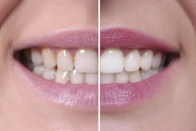 zdrowy uśmiech efekty szczoteczki sonicznej