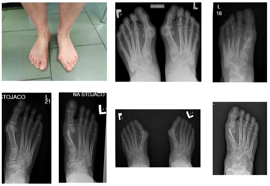 haluksy stopnie deformacji porównanie